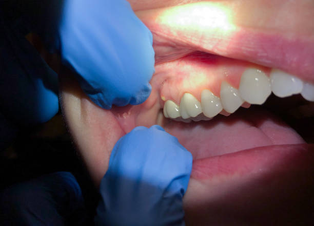 Best Lost Filling or Crown Replacement in Redland, MD
